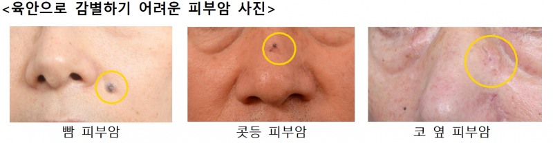 "점이나 검버섯 등 육안 감별 어려운 피부암, 초기 진단 중요"