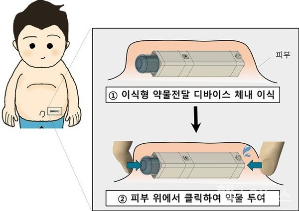 단한번의이식후피부위에서손가락으로‘클릭’하면정교한양의약물이방출되는디바이스