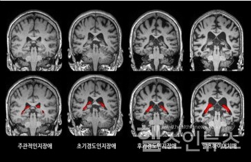 뇌영상에서맥락얼기의부피(빨간색)가치매가진행함에따라더증가한것을확인할수있다.