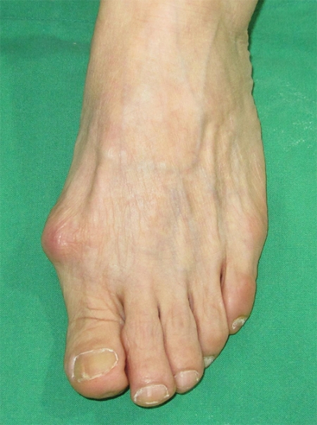 사진=무지외반증으로 발 모양이 변형된 모습 / 제공=바른본병원