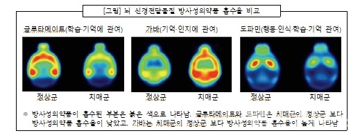 방사성의약품이흡수된부분은붉은색으로나타남.글루타메이트와도파민은치매군이정상군보다방사성의약품흡수율이낮았고,가바는치매군이정상군보다방사성의약품흡수율이높게나타난다