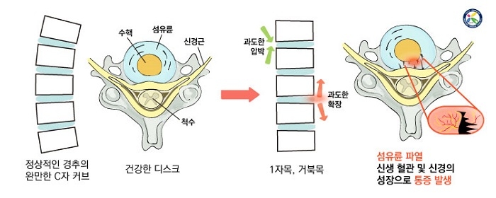 목디스크, 비수술적 치료 통해 통증 완화 기대