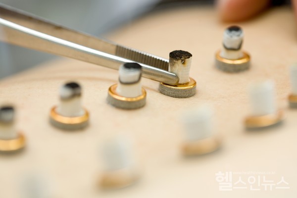 림프부종후유증환자의부종완화에뜸·물리치료가효과가있는것으로확인됐다.(사진제공:자생한방병원)