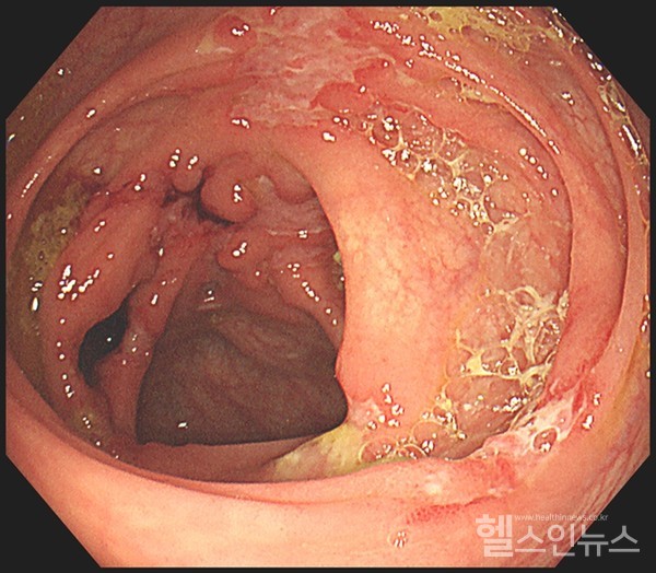 크론병환자의대장내시경모습