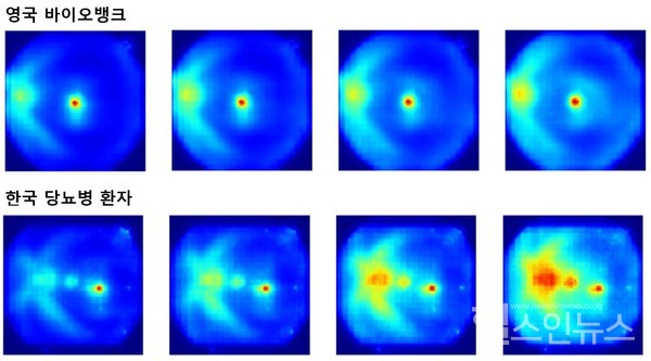 연구팀이개발한만성콩팥병예측알고리즘의특징지도(Saliencymap).오른쪽으로갈수록고위험군으로분류된망막사진이다.AI는망막혈관주위부분(붉은색)으로만성콩팥병발생위험도를평가했다.