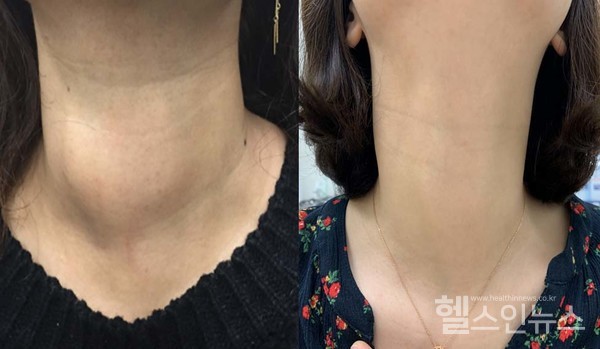(좌측)고주파절제술전,양성갑상선결절로튀어나온환자의목모습(우측)고주파절제술후1년뒤,흉터없이갑상선결절이치료된환자의목모습
