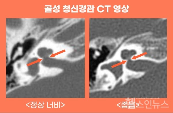 골성청신경관CT영상.정상너비가확보되면인공와우후말소리변별력정확도가평균79%에달한다.
