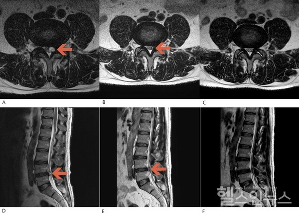 한의통합치료를통한요추후관절낭종환자의치료경과