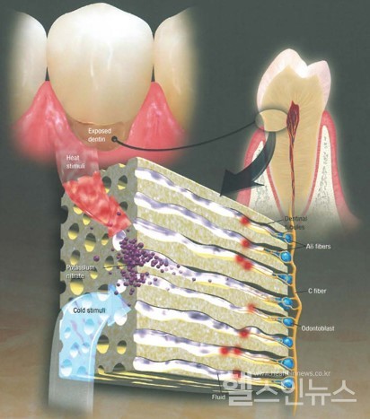 신경둔감화(NerveDesensitization)출처:KennethMarkowitzJClinDent2009