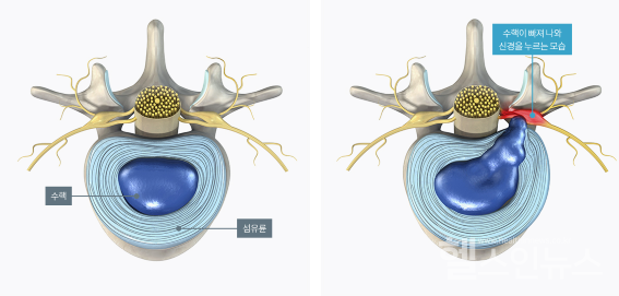 정상적인수핵과섬유륜모양(오름쪽),섬유륨파열로수핵이비져나온상태(왼쪽)