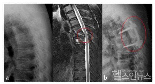 비소세포폐암이척추로전이되어걷지못했던50대환자의X-ray와 MRI검사사진.전이암으로인해병적골절된척추부위의신경을감압하고기구로고정하는척추유합술과수술후방사선치료를병행한결과,환자의통증은사라지고보행도다시가능해졌다.