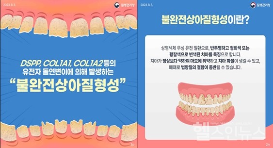 ‘불완전상아질형성’소개포스터(출처:질병관리청희귀질환헬프라인누리집)