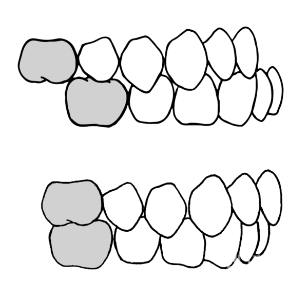 (위)III급부정교합(아래)정상교합