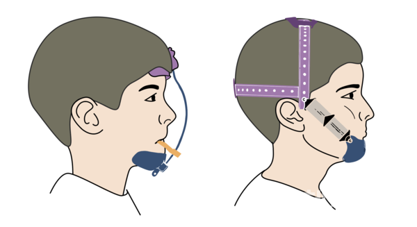 상악전방견인장치(왼쪽)와이모장치