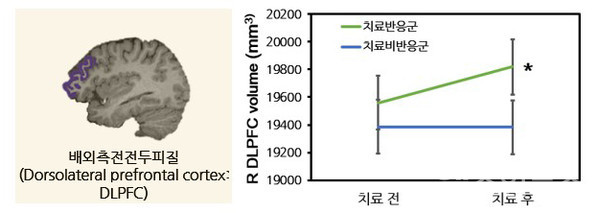 항우울제치료전후배외측전전두피질부피의변화(R = right(우측),*p0.05로통계적으로유의미함)