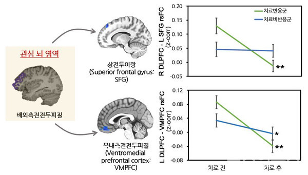 항우울제치료전후배외측전전두피질휴지기기능적연결성의변화(R = right(우측),L = left(좌측)