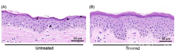 치료후표피(B)의두께와세포층의증가및표피-진피연결부물결구조의증가가나타남.