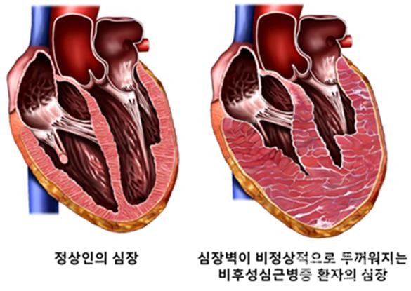 비후성심근증모식도