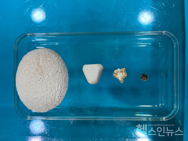 반려동물요로수술에서나온다양한성질의결석들(사진제공:삼성동물병원)