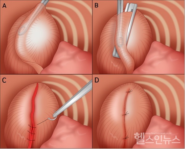 (A)횡경막을포크로스파게티를잡는방식으로잡고감아(B)안전하게절제하고(C)(D)강화,봉합하는방식이다.