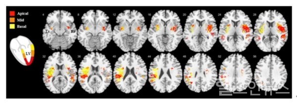 좌심실을세부위로나누어분석했을때좌심실움직임변화에이상이생긴곳에따라뇌의손상영역도조금씩달랐던것을확인할수있다.해당영역에뇌졸중이발생하면좌심실의각부위도영향을받는다는의미다.빨간색(정점),주황색,노란색(기저부)으로구분