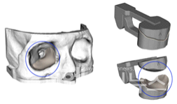 환자의CT영상기반으로수술전,3D프린팅된환자맞춤형임플란트가이드모습.
