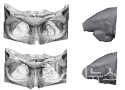 수술후안와용적이감소된것을분석한모습(상)수술전안와용적,(하)수술후정상으로회복된용적.