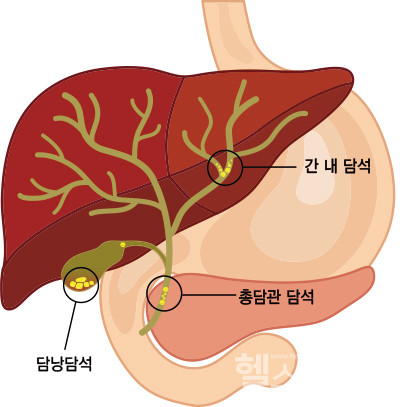 담석의발생부위별명칭(제공:강동경희대병원)