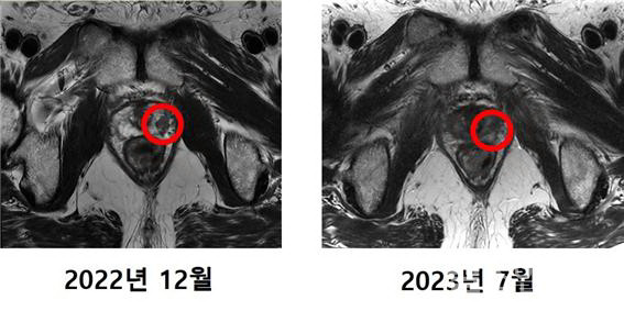 최씨의MRI촬영사진.기존에발견됐던암조직(왼쪽사진표시)이치료후에는발견되지않았다.(사진제공:연세암병원)