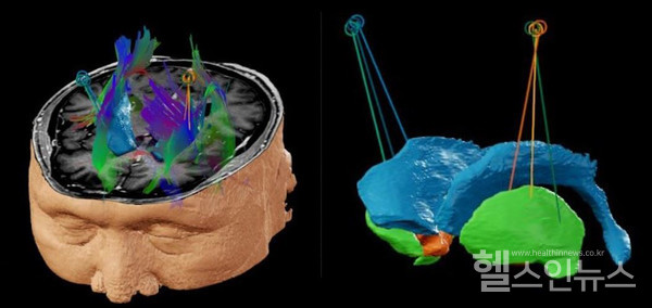 세브란스병원신경과와신경외과가협업한뇌이식수술모식도,뇌양측조가비핵(putamen)의전방,중간,후방부위에균등하게이식했다