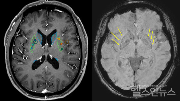 이식전(왼쪽)후(오른쪽)MRI,이식후MRI에서성공적으로세포가이식된부위를확인할수있다(화살표)