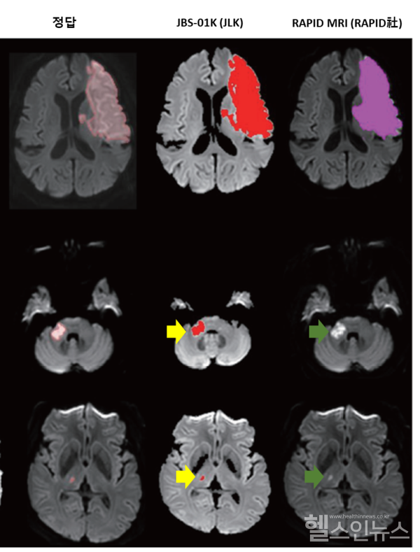 작은뇌경색병변을전문가정답(왼쪽),JBS-01K(JLK)는정확하게탐지하였으나(중앙,노란색화살표),RAPIDMRI는탐지하지못하였음(오른쪽,초록색화살표)(제이엘케이제공)