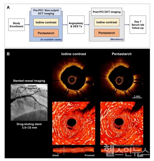 연구계략도(A)와3D로구현한DES약물용출스텐트,OCT최적간섭단층촬영,PCI경피적관상동맥중재술이미지