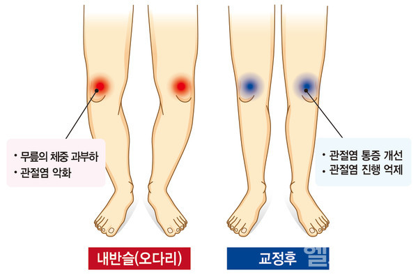관절염으로인한오다리교정전(왼쪽)후