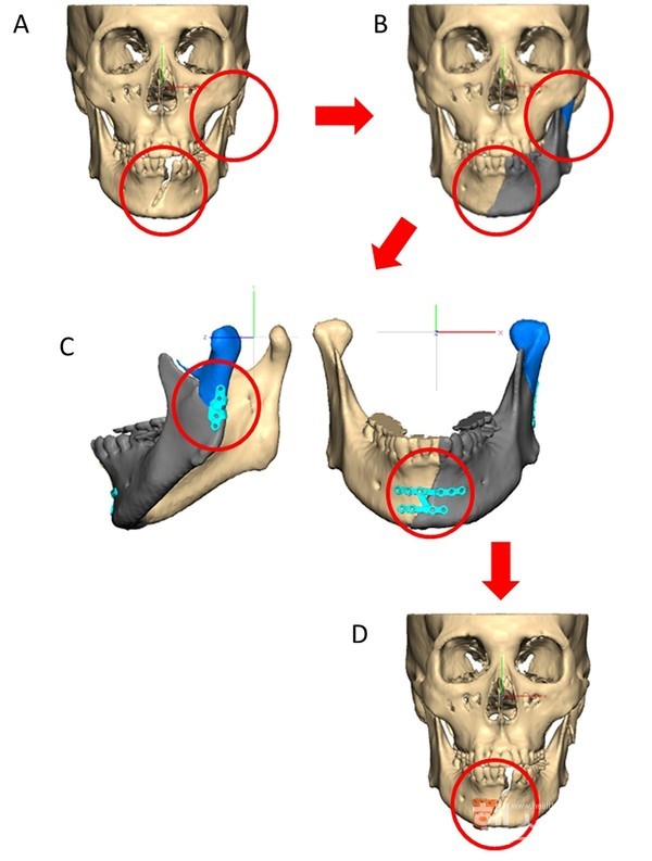 환자맞춤형안골절수술모식도(A)환자의CT를3차원적으로재구성(B)가상수술로골절편을재위치로정복한모습(C)환자맞춤형금속판디자인(D)환자맞춤형수술가이드디자인