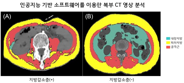 인공지능기반소프트웨어로체성분분석한루게릭병환자의복부CT영상.지방감소증동반한환자(A)는CT검사1개월째사망한반면,지방감소증동반하지않은환자(B)는35개월(관찰기간)동안생존함.