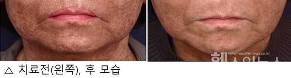 리엘흑색종에서복합치료전후비교모습