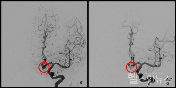 (좌)뇌혈관이꽈리모양으로부푼뇌동맥류환자의사진/(우)코일색전술치료를받은뇌동맥류환자의사진