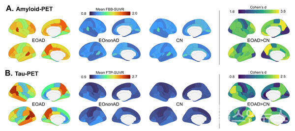 조기발병알츠하이머환자에서아밀로이드(위)와타우(아래)축적양의뇌지역적분포.조기발병알츠하이머환자(좌측)의경우,조기발병치매(비알츠하이머성)환자군(가운데)와정상군(우측)에비해아밀로이드와타우단백질분포가높은것으로나타났다.