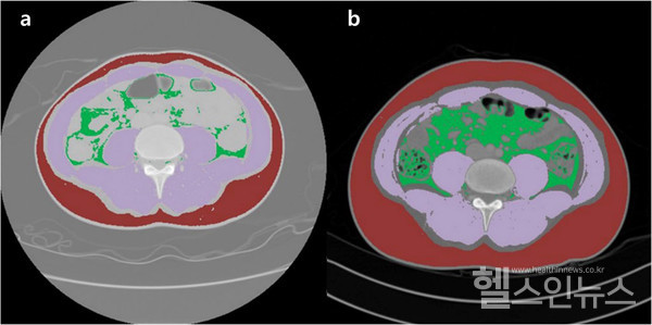 생물학적제제사용하기전환자복부CT사진예시/b:생물학적제제를사용후환자의복부CT사진예시.내장지방및피하지방이많이늘어난것을확인할수있다.