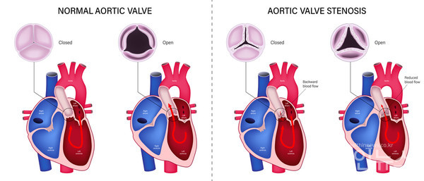 (좌)정상대동맥판막인경우혈액이정상적으로순환되지만,(우)대동맥판막협착증으로좌심실에서혈액이역류하거나원활히분출되지못하고있음