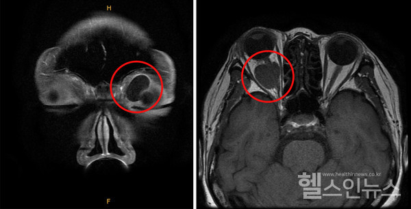 (좌측)좌측안와앞쪽에생긴낭성종괴,(우측)우측안와뒤쪽에생긴시신경종양