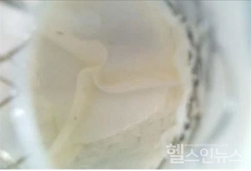 맞춤형우심실유출로에삽입된스텐트판막을내시경카메라로촬영한모습