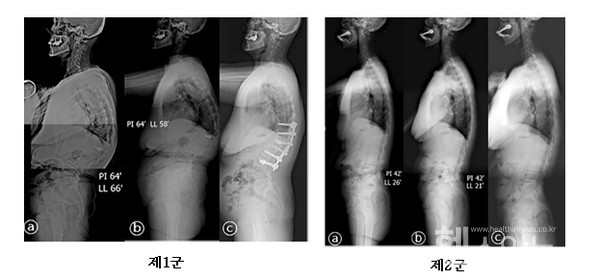 우선적으로보존적치료를시행하였으나,척추변형이나신경학적증상이발생하여결국에수술적치료가필요했던환자를제1군,성공적으로보존적치료가완료되었던군을제2군으로나누어,척추X선사진과MRI검사소견을비교하였다.제1군환자는척추뼈가손실된정도와허리가앞으로굽는초기후만변형이심했고,결국에골절1개월후척추변형과하지마비가발생하여척추유합술로치료하였다.제2군환자는상대적으로초기후만변형이적었고,골절3개월후통증과신경증상없이보존적인방법으로치유된것을확인하였다.
