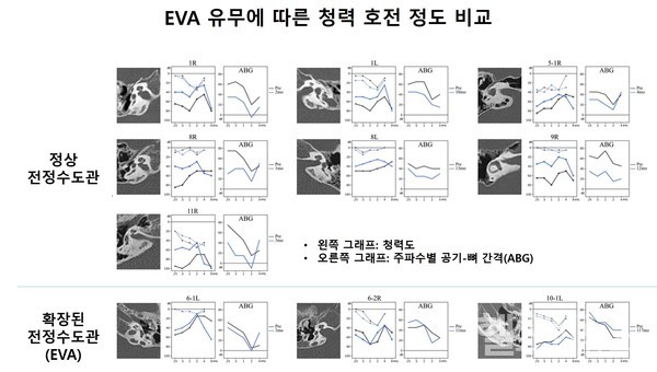 확장된전정수도관(EVA)유무에따른중이수술후air-bonegap(ABG)을통해살펴본청력호전정도에대한비교