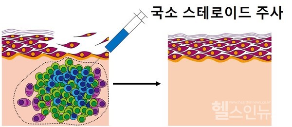 만성재발성천포창에국소스테로이드주사치료를하기전,후피부병변의변화