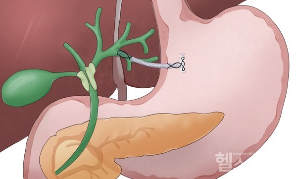 새로운금속배액관이간내담도와위를연결하여담도배액을시행하는모식도