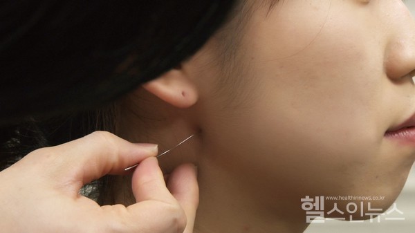 한의사가턱관절장애환자에게침치료를시행하고있다