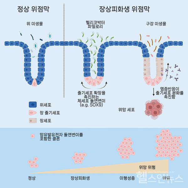 정상위점막이장점막처럼변하는'장상피화생'위암진행에관여하는유전자변이규명