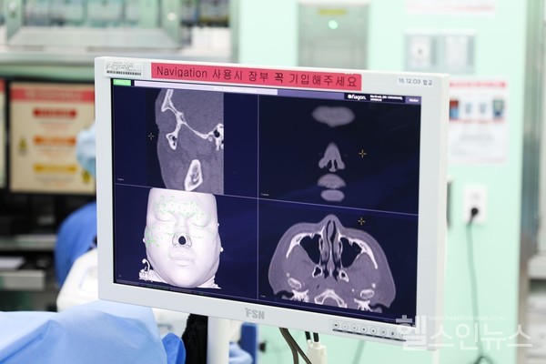 내비게이션시스템을이용한안와골절수술모습